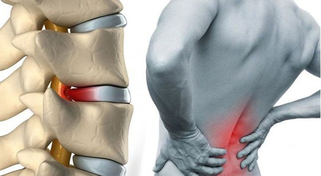 Bel ağrısından kurtulma yolları 7