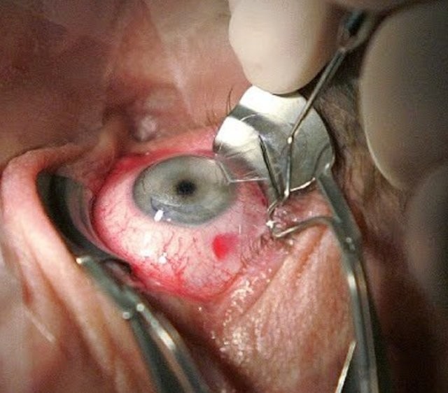 Ameliyat ortasında dehşete uyanmak 20