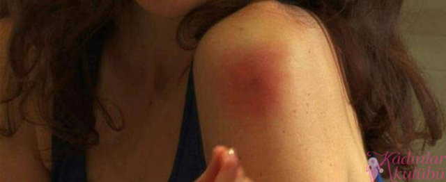 Sivrisinek en çok kimleri ısırır 42