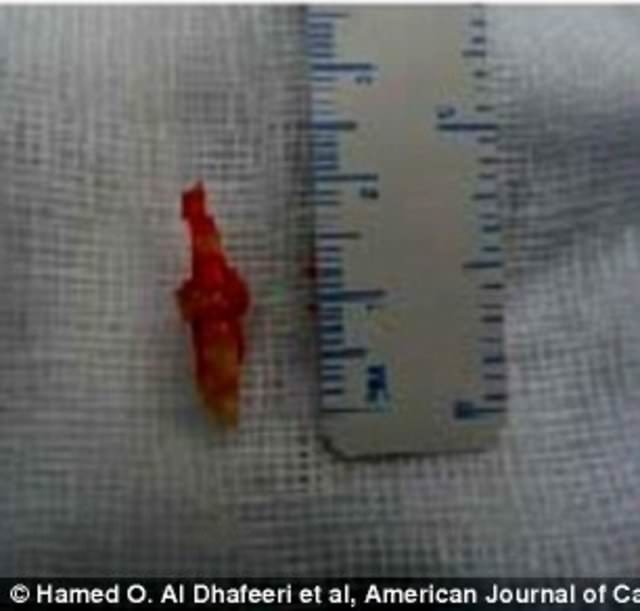 Dünyanın en garip hastalıkları 24