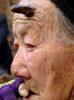 Dünyanın en garip hastalıkları 64