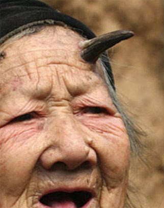 Dünyanın en garip hastalıkları 66