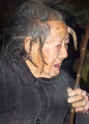 Dünyanın en garip hastalıkları 67