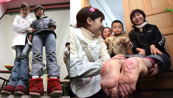 Dünyanın en garip hastalıkları 88