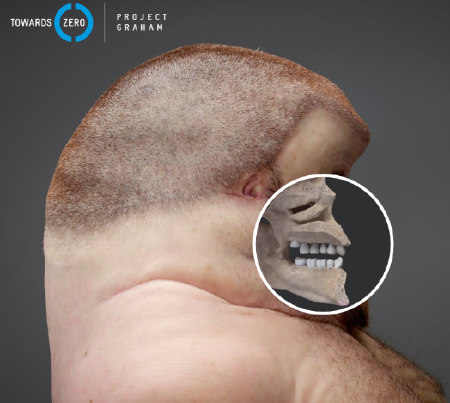 İşte trafik kazalarına dayanıklı insan: Graham 7