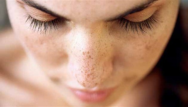Güneş lekelerine karşı 5 etkili çözüm 8