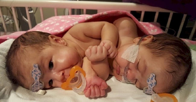 Kalbinden yapışık ikizler 1