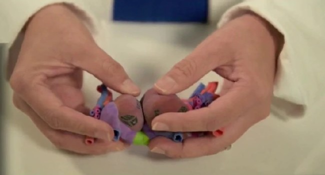 Kalbinden yapışık ikizler 3