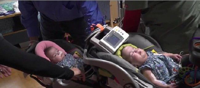 Kalbinden yapışık ikizler 4