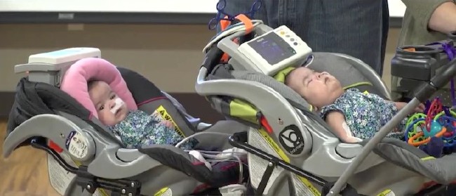 Kalbinden yapışık ikizler 5