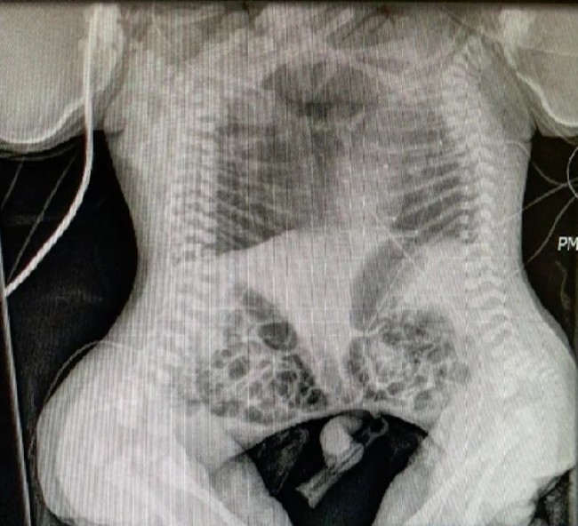 Kalbinden yapışık ikizler 7