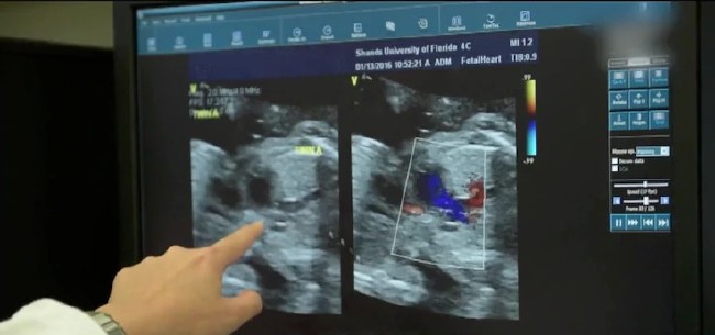 Kalbinden yapışık ikizler 8