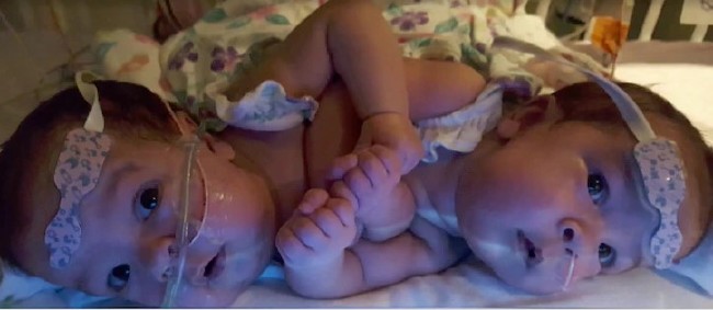 Kalbinden yapışık ikizler 9