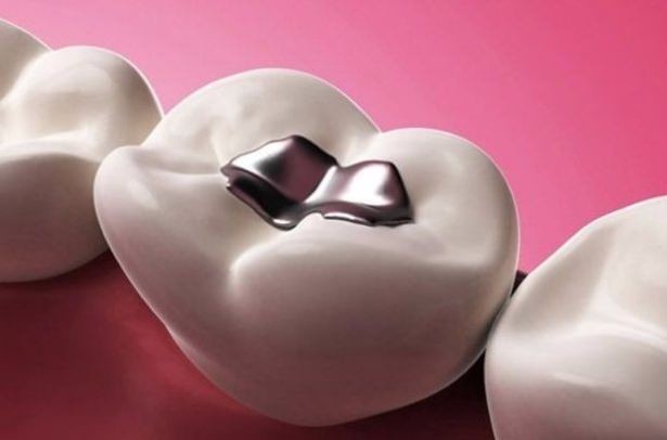 Uzmanlar uyarıyor ağızdaki dolgu sayısına dikkat 10