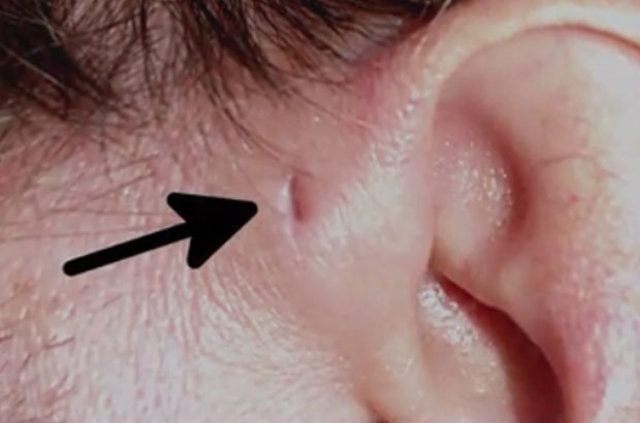 İnsan kulağının üzerinde yer alan delik nedir? 6