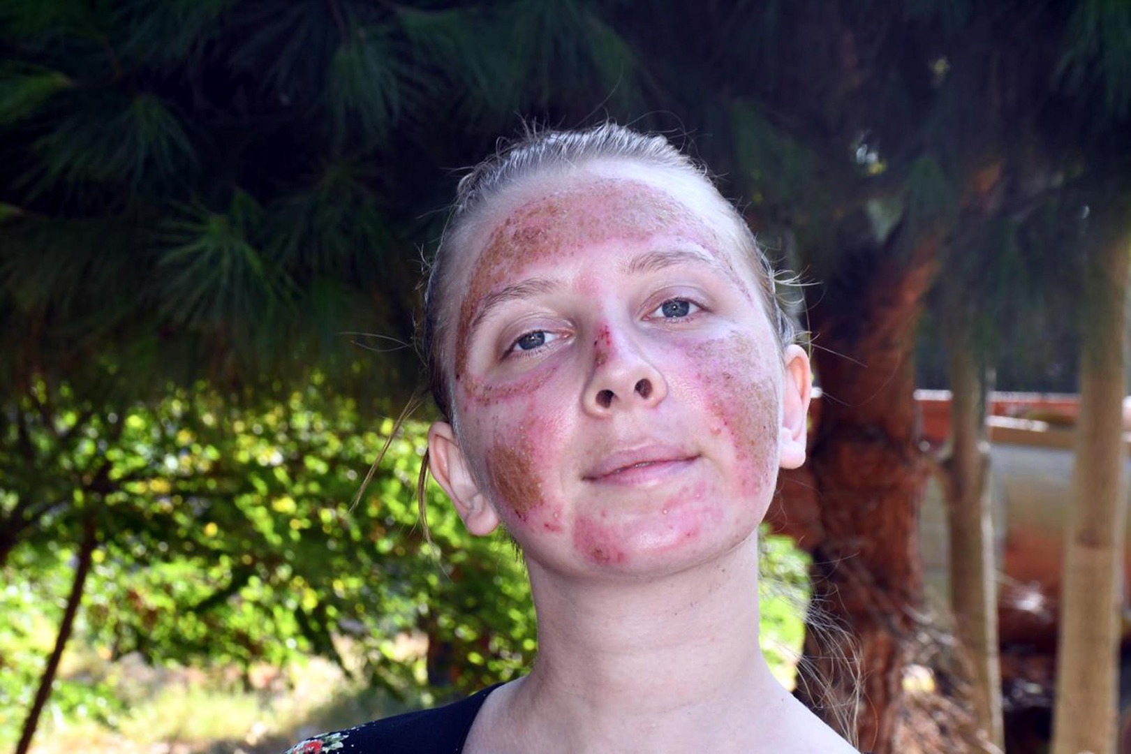 Cilt bakımı sonrası kabusu yaşayan genç kadın 6 ay tedavi görecek 8