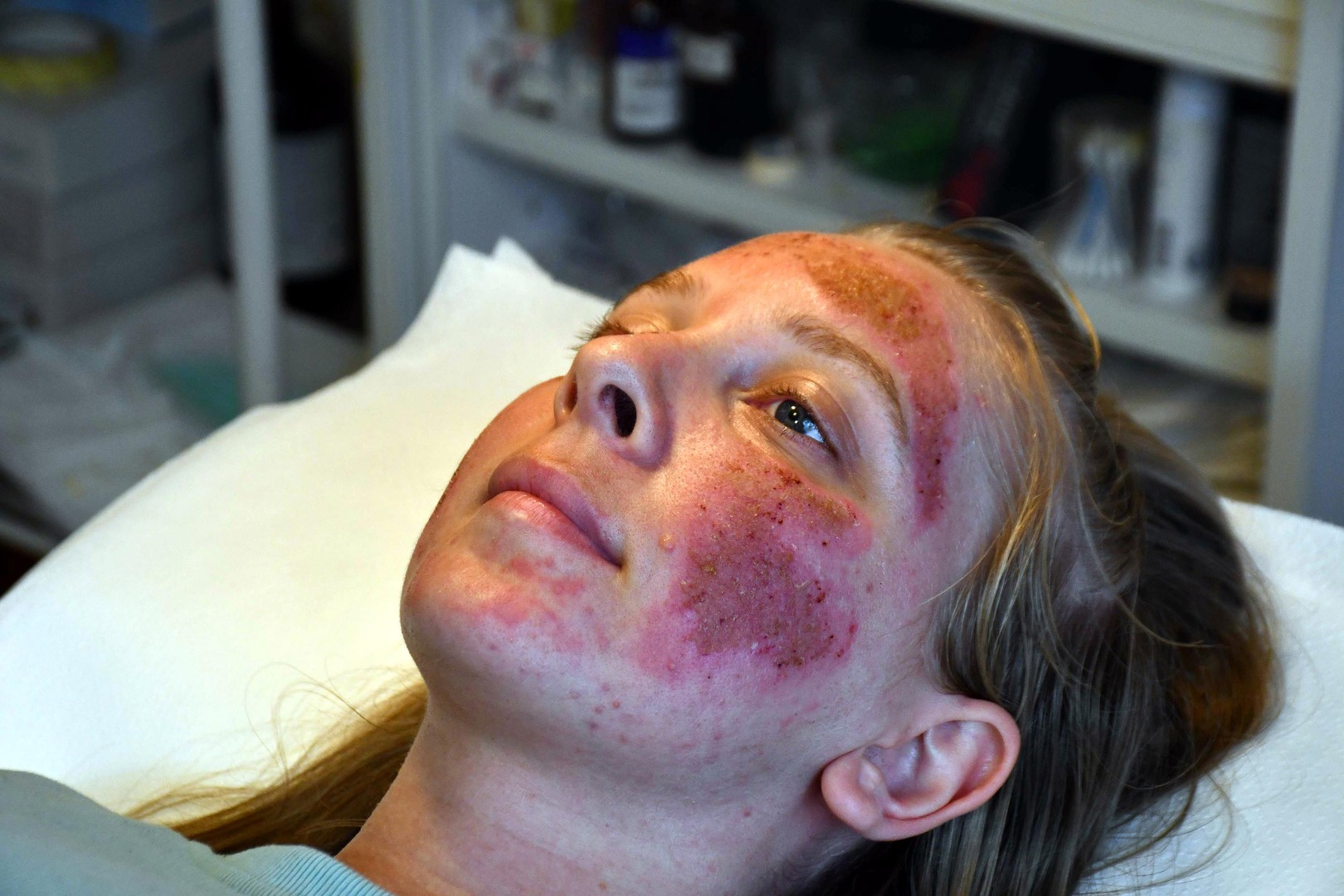 Cilt bakımı sonrası kabusu yaşayan genç kadın 6 ay tedavi görecek 7