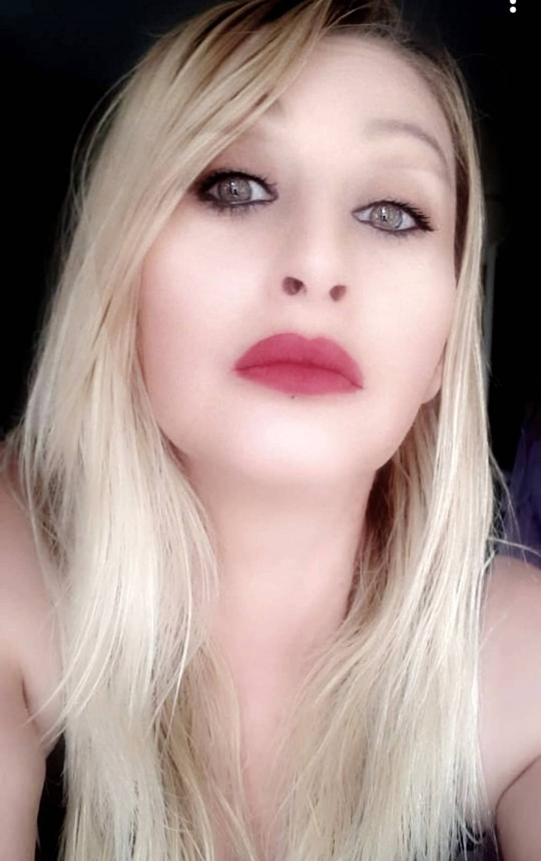 Estetik mağduru kadın: Gülmeyi unuttum, mimiklerimi kaybettim 8