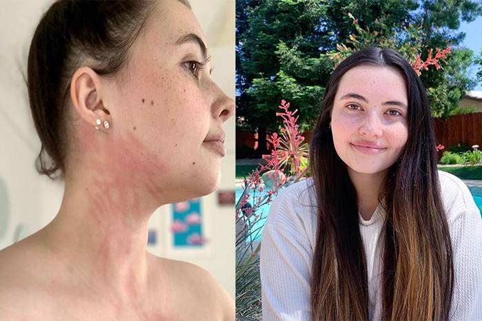 Bildiğiniz tüm hastalıkları unutun! Genç kadının suya alerjisi çıktı, ona terlemek ve ağlamak bile yasak 9