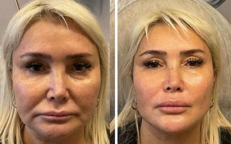 Yonca Evcimik'in estetikli hali şok etti! Kim der 60 yaşında, son hali "paranın gücü" dedirtti 4