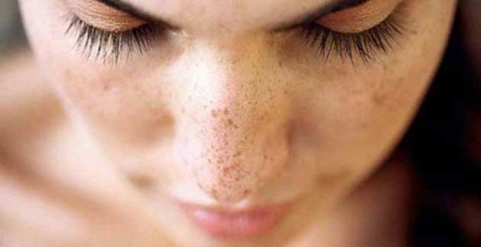 Yazın artan güneş lekelerine dikkat