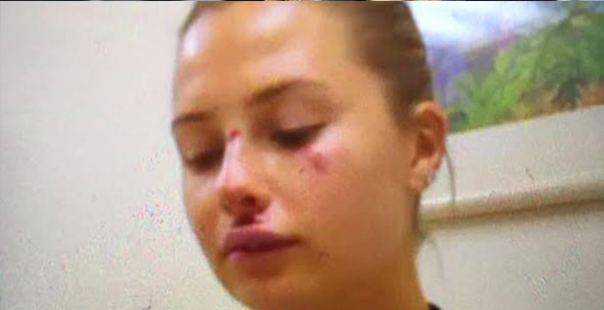 Serdar Ortaç'ın eşi Chloe kaza sonrası bu hale geldi