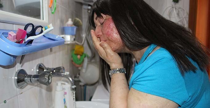 Hastalığı sebebiyle yüzünü ancak yıllar sonra yıkayabildi