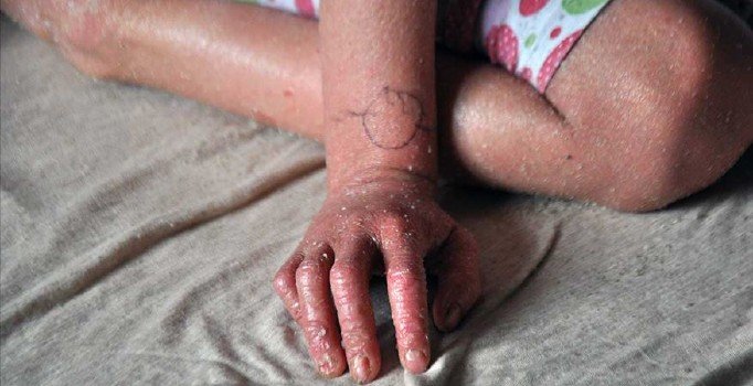 'Balık pulu' hastalığı için yerli ilaç atağı