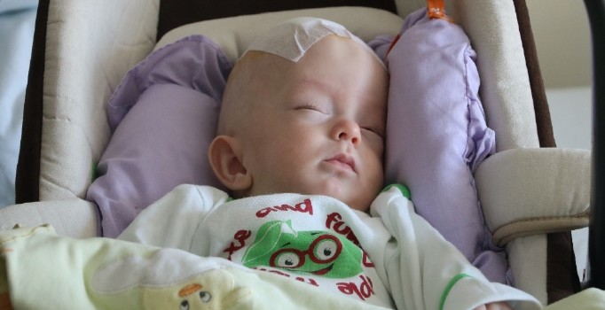 Prematüre bebeğe beyin ameliyatı