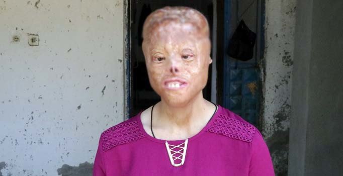 Sağlık Bakanlığı yüz nakli bekleyen Leyla için harekete geçti