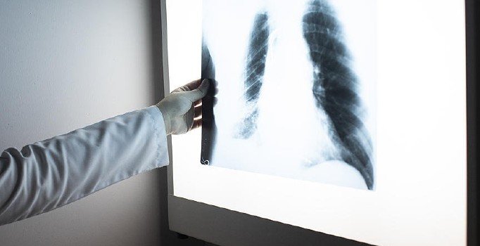 Abdi İbrahim'den tüberküloz uyarısı: İnsandan insana bulaşabiliyor