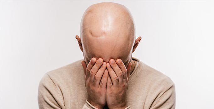 Kemoterapiyle saç dökülmesi sona eriyor