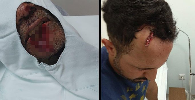 Kayınpederinin dudağını ısırarak parçalayan damat tutuklandı