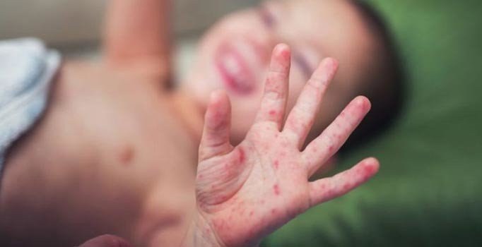 Samoa'daki kızamık salgınında ölü sayısı 25'e yükseldi