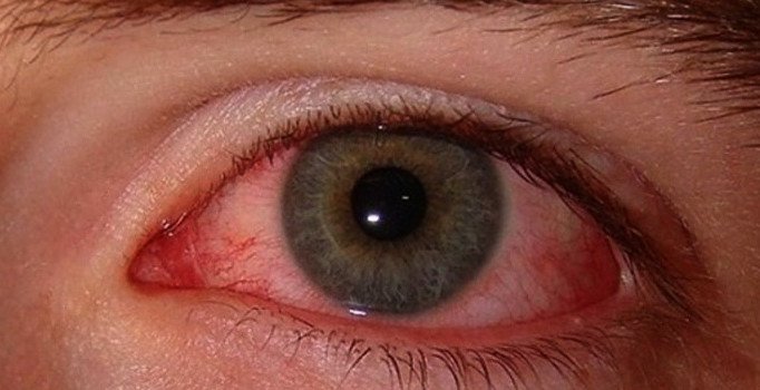 Göz kanlanması neden olur? Göz kanlanması nasıl geçer?