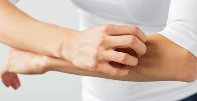 Uyuz salgını arttı, parazit de ilaca direnç sağladı | İstanbul'da uyuz salgını var mı?