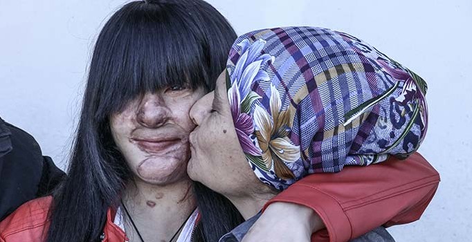 Yüzüne asit atılan Berfin'den Cumhurbaşkanı Erdoğan'a teşekkür