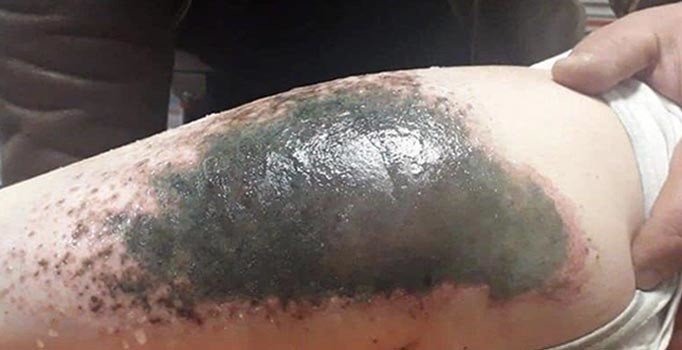 Afyonkarahisar'da kar topu oynayan çocuklarda yanık ve çürük oluştu