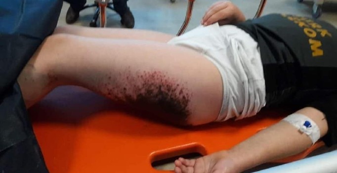 Kar topu oynarken yanan çocuklara doku nakli yapılacak