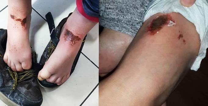 Karla oynarken yanan 2 çocuğa doku nakli yapılacak