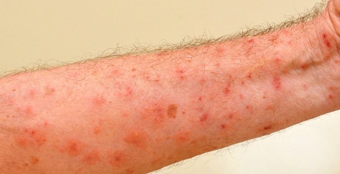 "Uyuz vakalarında artış" uyarısı