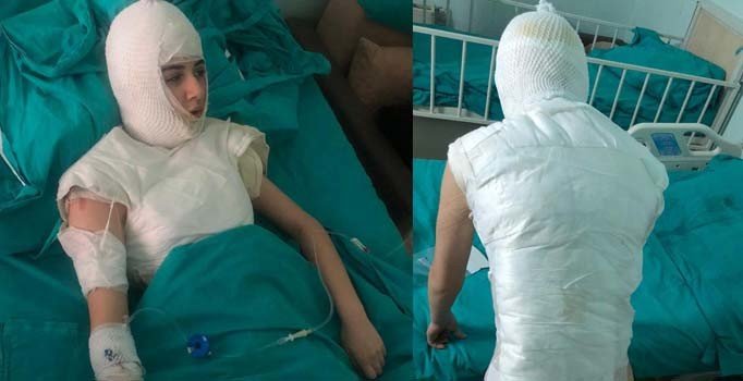 Üvey anne dehşeti! Başından aşağı kaynar su dökerek haşladı