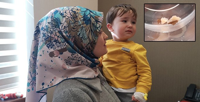 Zatürre teşhisi konulan küçük çocuğun akciğerine badem saplandığı ortaya çıktı
