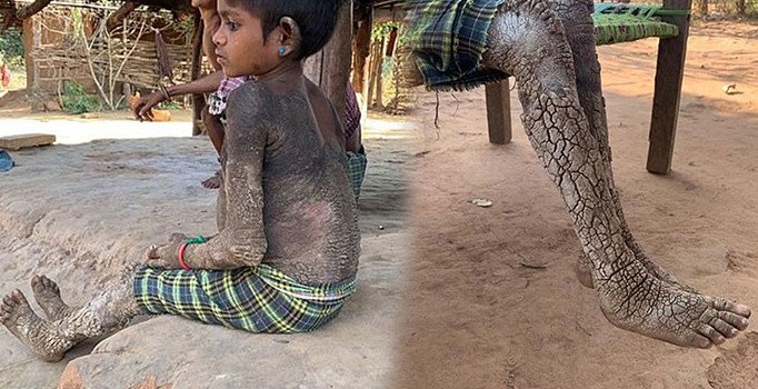 Her geçen gün taşa dönüşen küçük kızın dramı