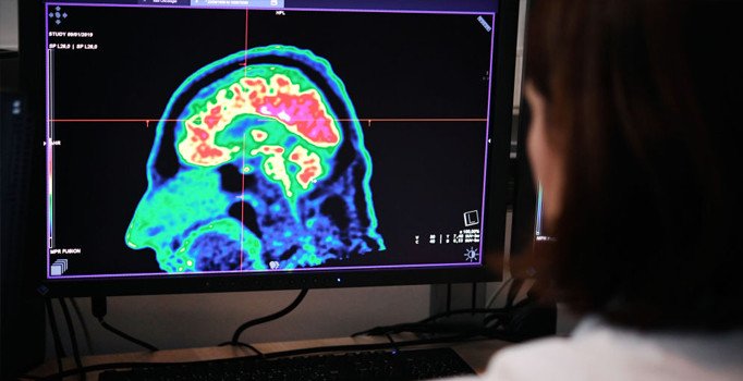 Beyinleri küçük olanlar davranış bozuklukları gösteriyor