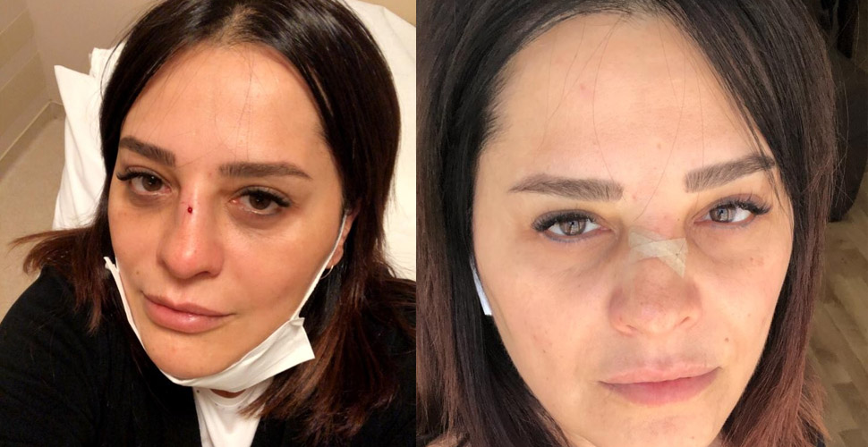 Ünlü şarkıcı Reyhan Karaca’nın burnu kırıldı