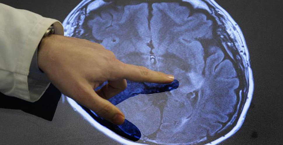 Bilim insanlarından yeni uyarı: Kovid-19 beyin hasarına neden oluyor