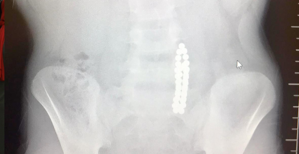 Midesinden 42 adet mıknatıs topu çıktı