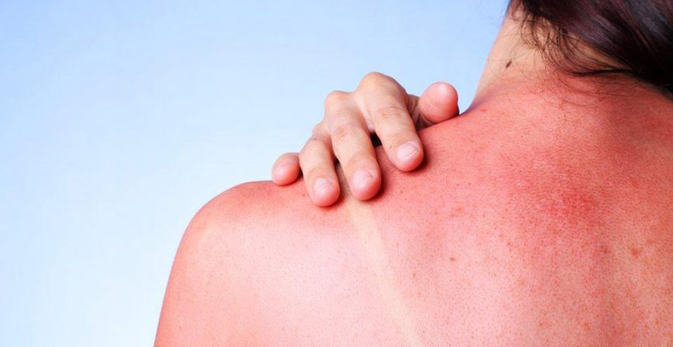 'Güneş yanığına kesinlikle diş macunu ve yoğurt sürmeyin'