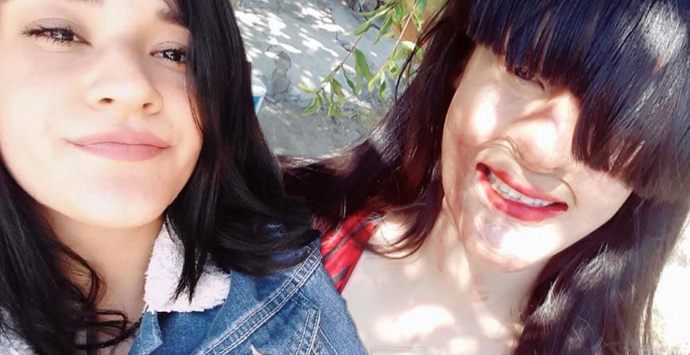 Yüzüne asit atan saldırganı affeden Berfin Özek: Bunu nasıl yapabildim?